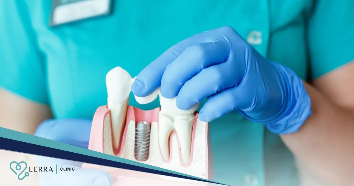 Preparations Before Dental Implantation
