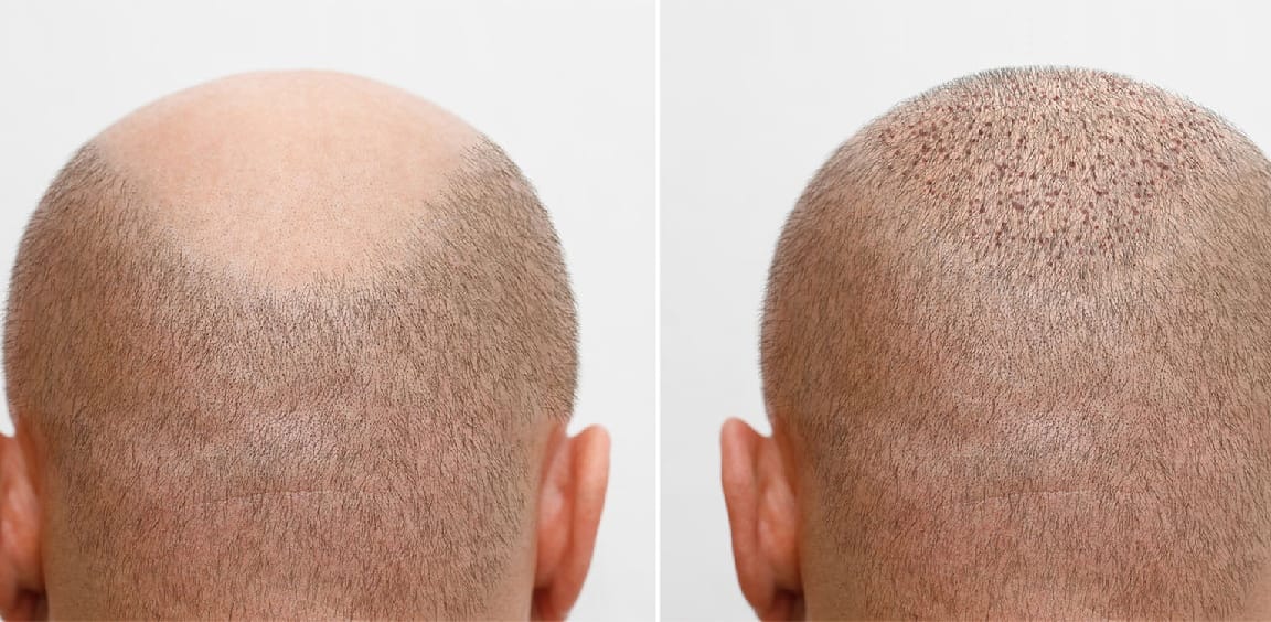 Preparing for Your Hair Transplant