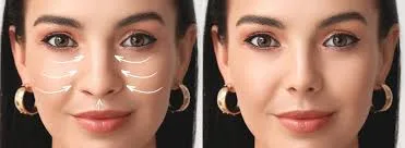 جراحة الأنف لمعالجة انسداد الأنف ومشاكل التنفس