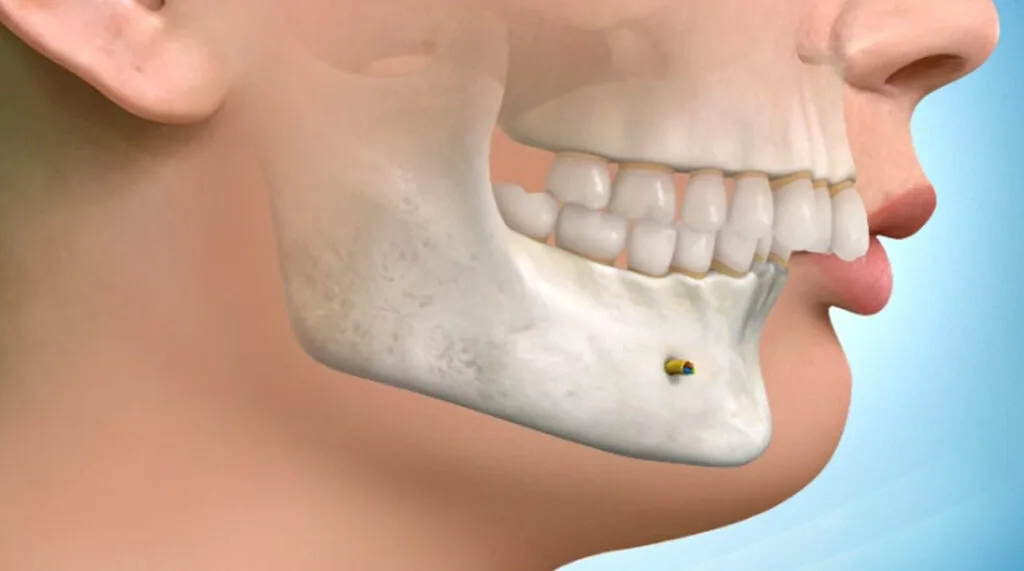 The Role of Orthognathic Surgery in Facial Proportion and Alignment