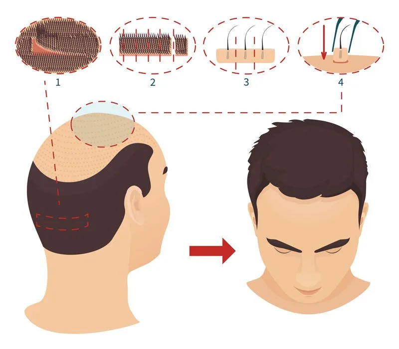 hair transplant techniques