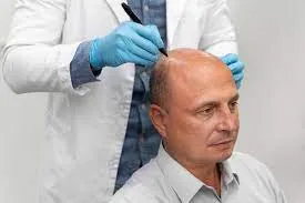 زراعة الشعر الطبيعية بتقنية DHI