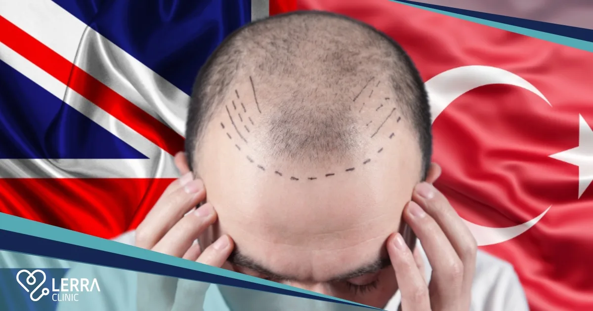 Hair Transplant Costs in the UK vs. Turkey