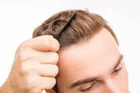 hairstyle after hair transplant