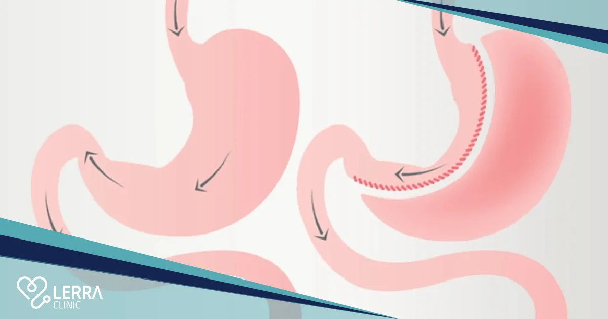 obesity surgery in Turkey