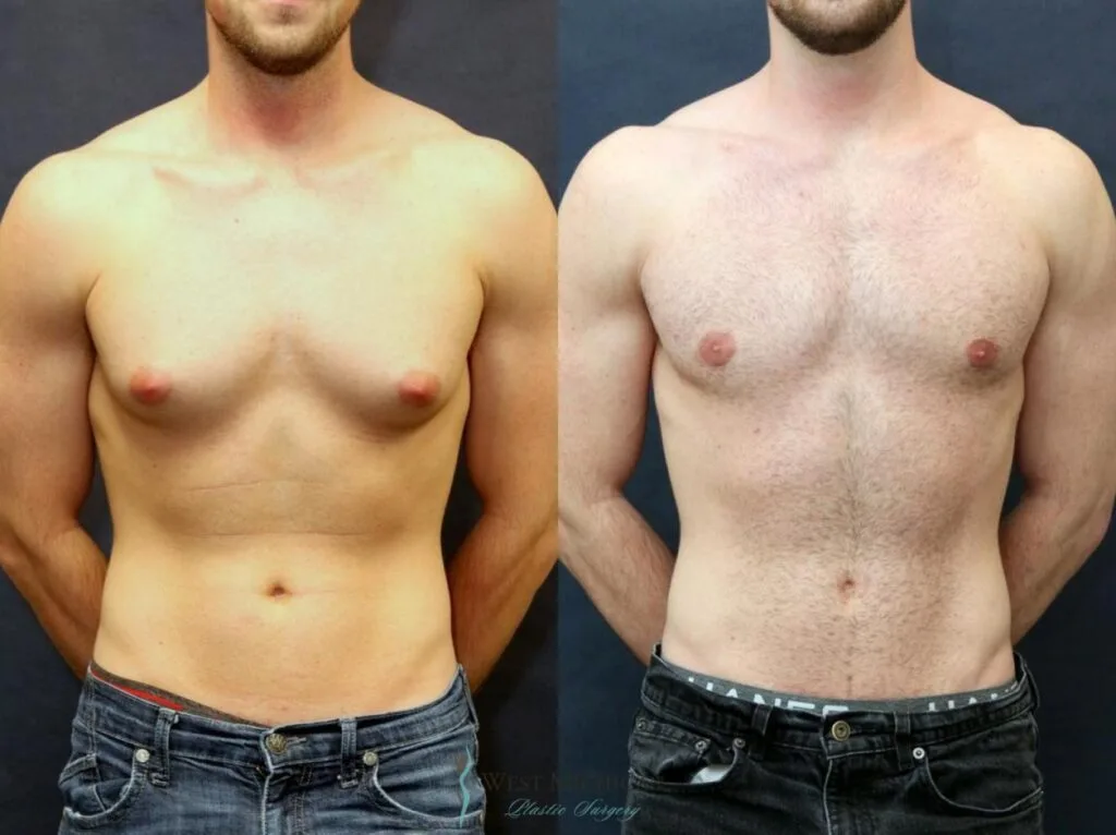 Gynecomastia