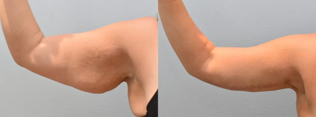 Chirurgie de lifting des bras