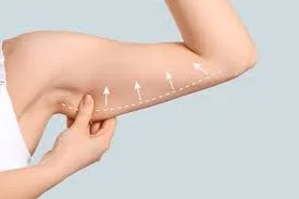 Chirurgie de lifting des bras