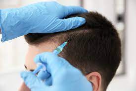 hair transplant Cost in Turkey 2025