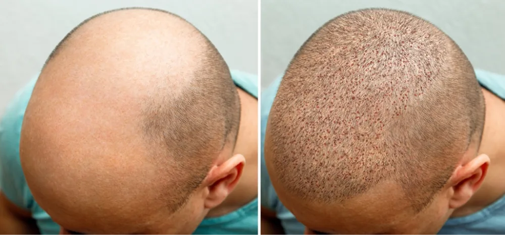 Le processus de greffe de cheveux