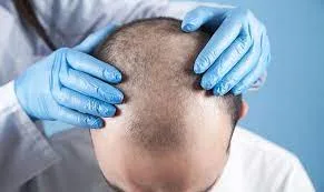 Le processus de greffe de cheveux
