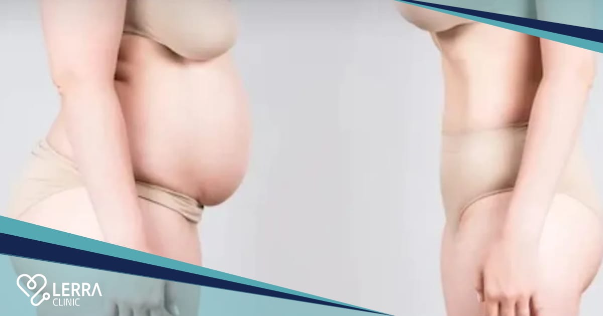 Liposuction for Women