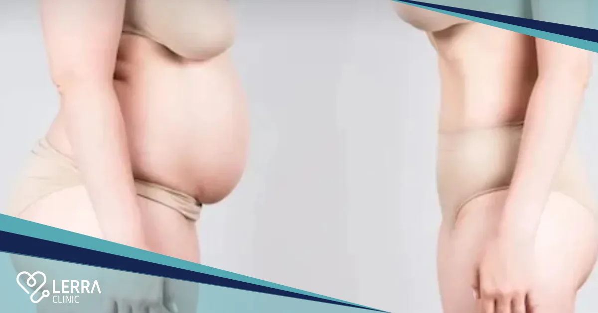 Liposuction for Women