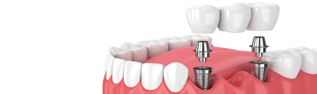 NEW TEETH IN TURKEY