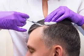 Preparing for a Hair Transplant