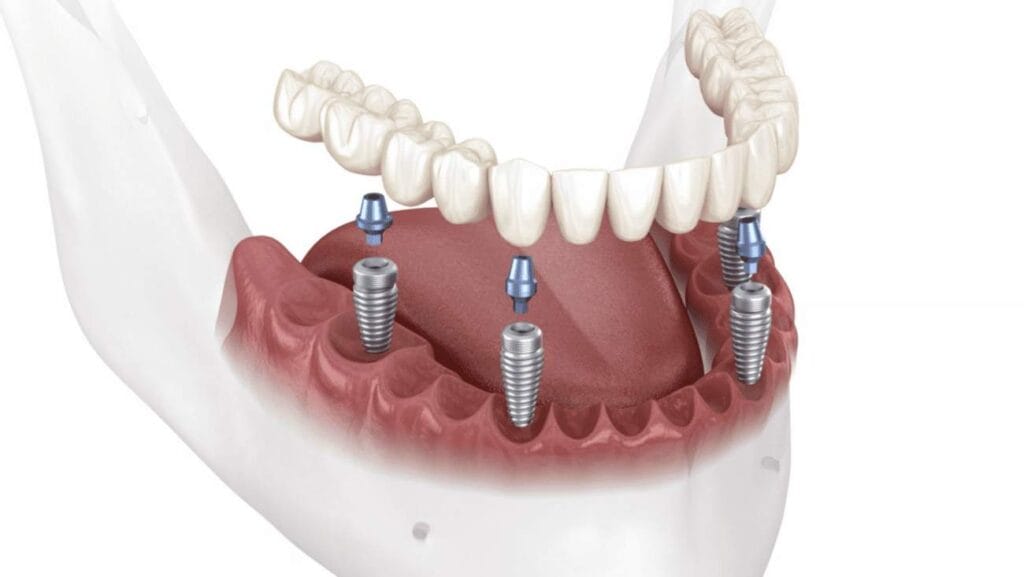 top teeth implants Turkey reviews