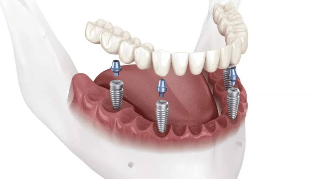 Dental Implants in Turkey Reviews