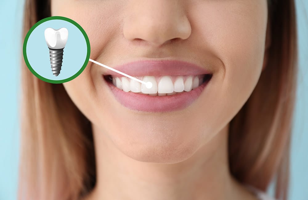 top teeth implants Turkey reviews