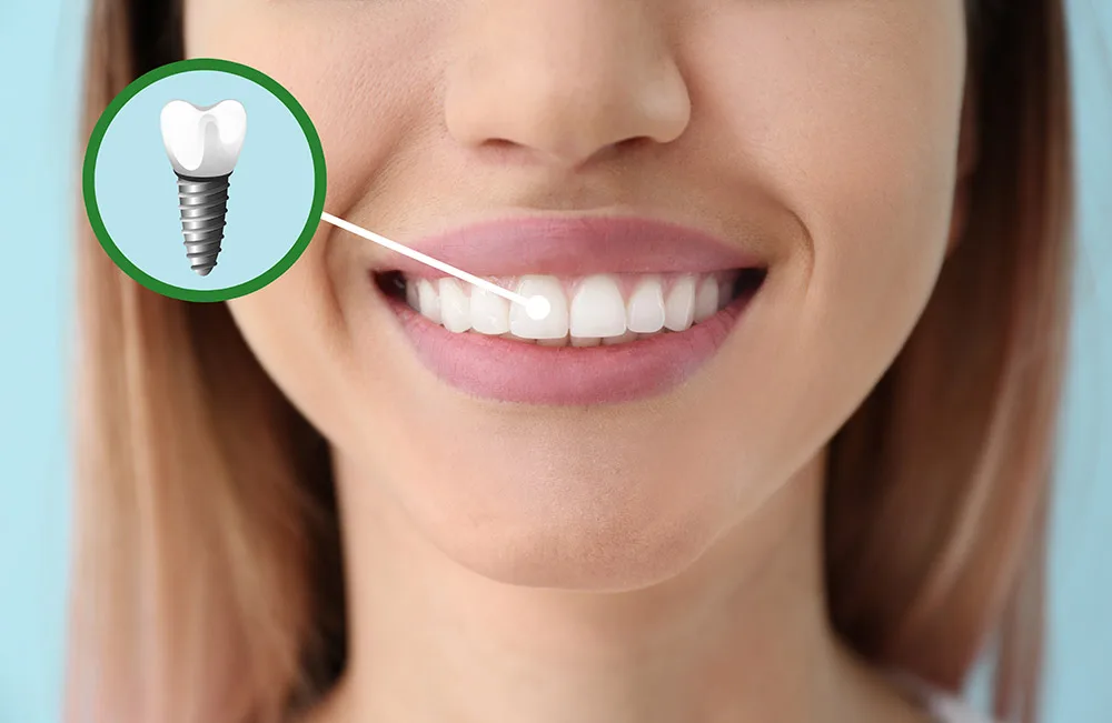 Dental Implants in Turkey Reviews
