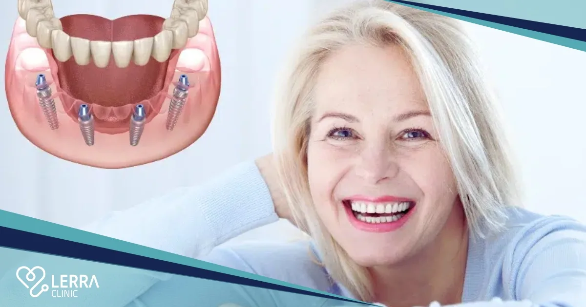 top teeth implants Turkey reviews
