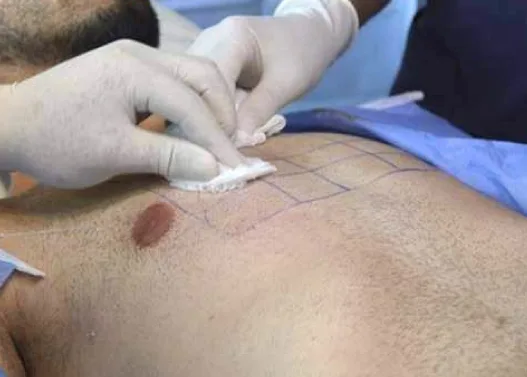 Body Hair Transplant in Turkey