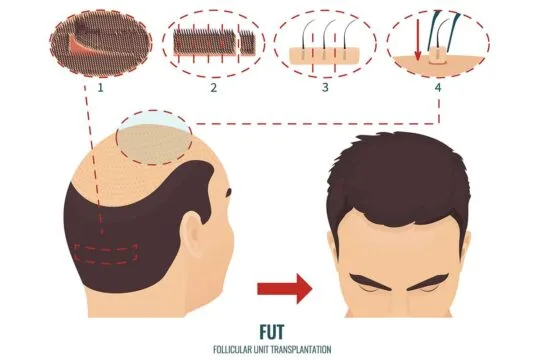 أفضل زراعة شعر بتقنية FUT