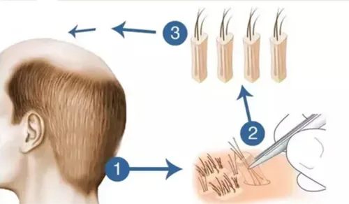 FUT hair transplant in Turkey