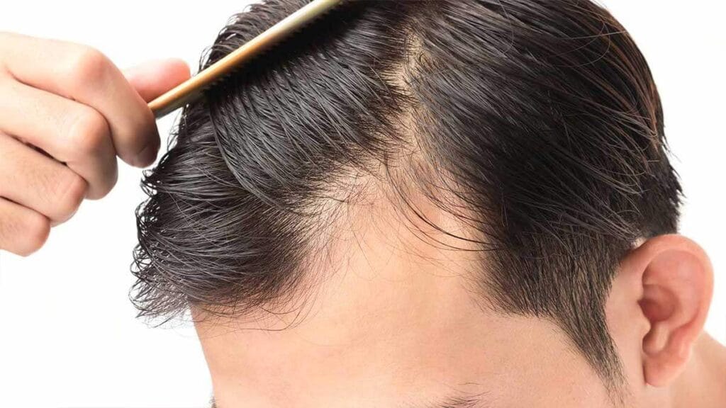 FUT hair transplant in Turkey