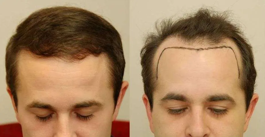 hairline transplants