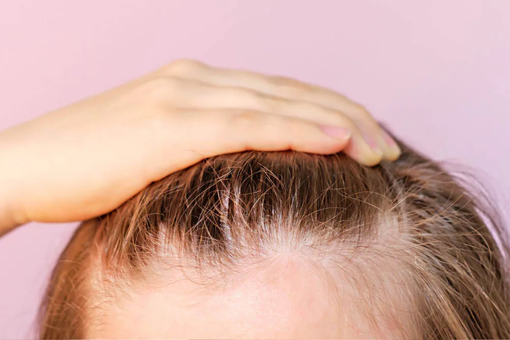 hairline transplants
