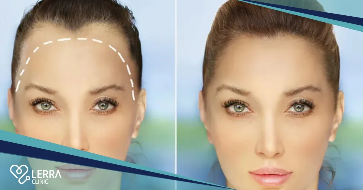 hairline transplants