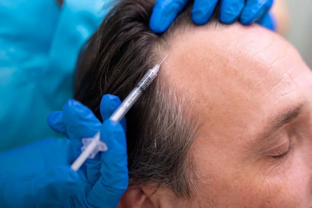 Turkish hair transplant cost