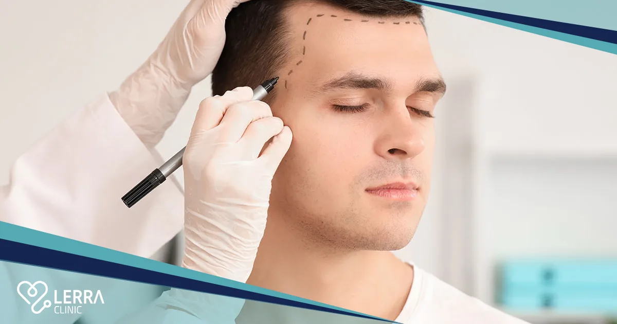 Turkish hair transplant cost