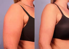 Arm Lift Turkey Packages & Prices