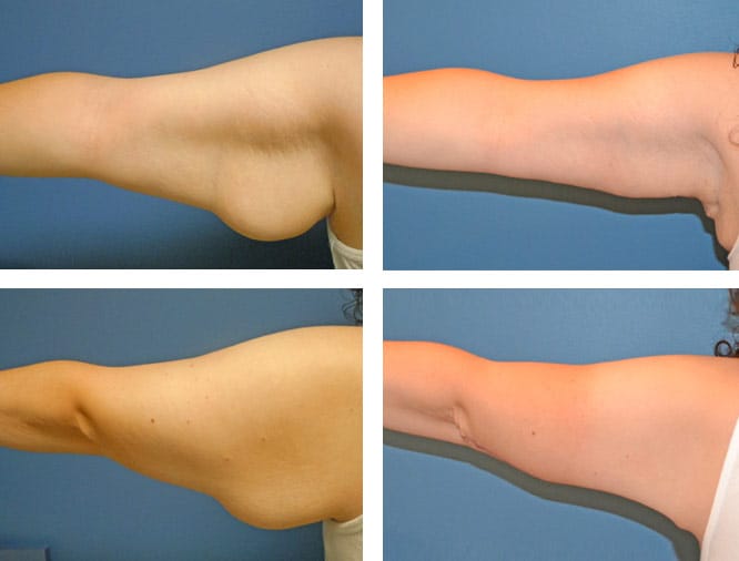 Arm Lift Turkey Packages & Prices