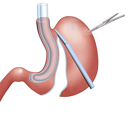 sleeve gastrectomy Turkey
