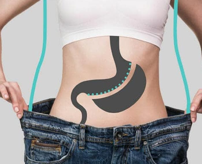 sleeve gastrectomy Turkey