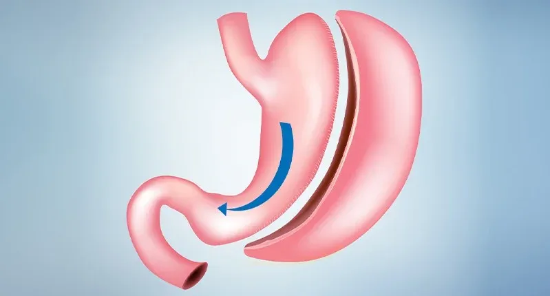 sleeve gastrectomy Turkey
