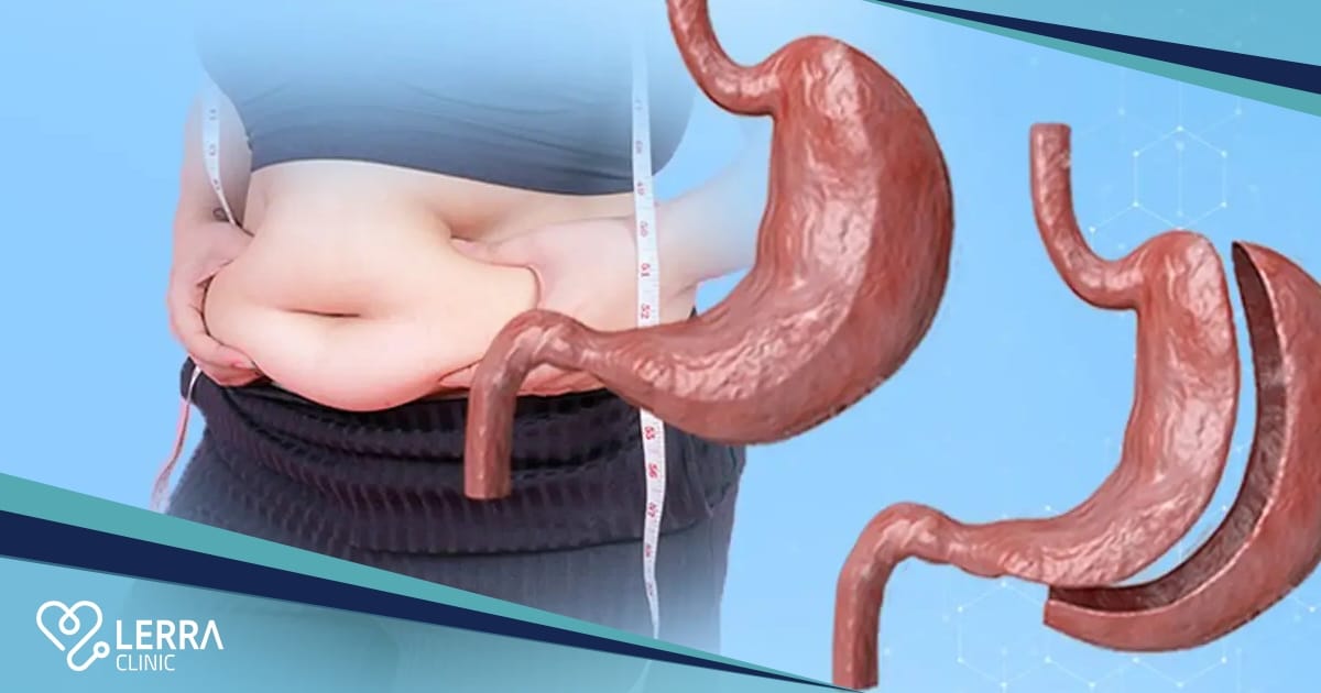 sleeve gastrectomy Turkey