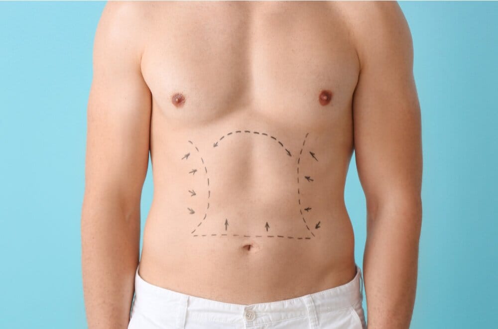 Decoding the Different Types of Liposuction