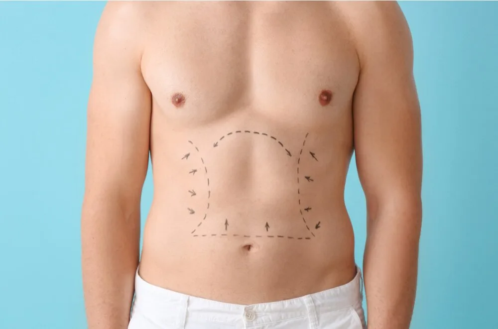 Decoding the Different Types of Liposuction