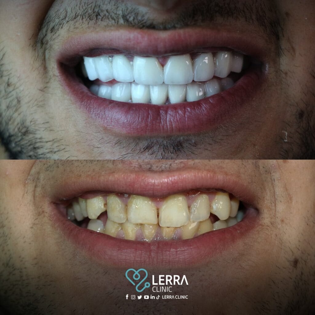 قبل و بعد - الأسنان