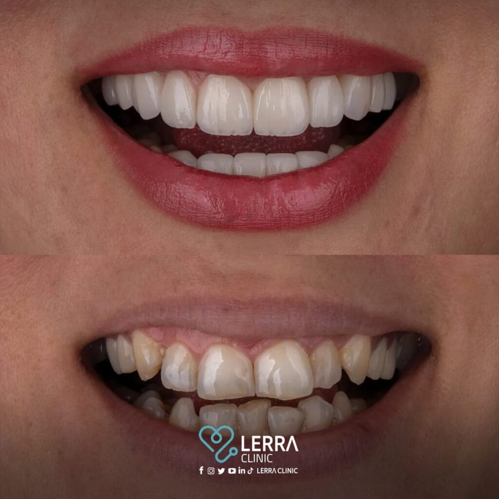 قبل و بعد - الأسنان