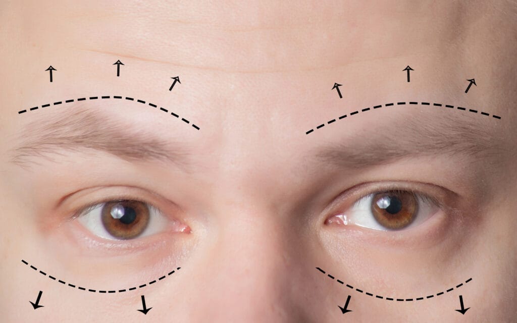 brow lift vs eyelid surgery