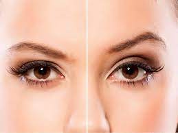 brow lift vs eyelid surgery