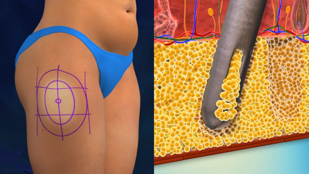 Everything You Need to Know About Liposuction