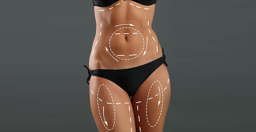 Everything You Need to Know About Liposuction