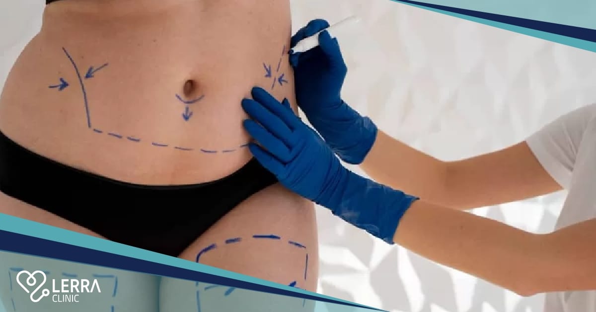 Everything You Need to Know About Liposuction