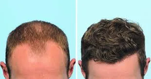 Expert Hair Transplant Solutions