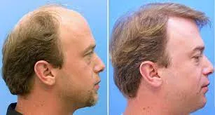Expert Hair Transplant Solutions
